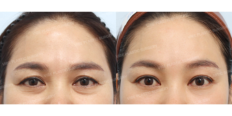 Before/After
