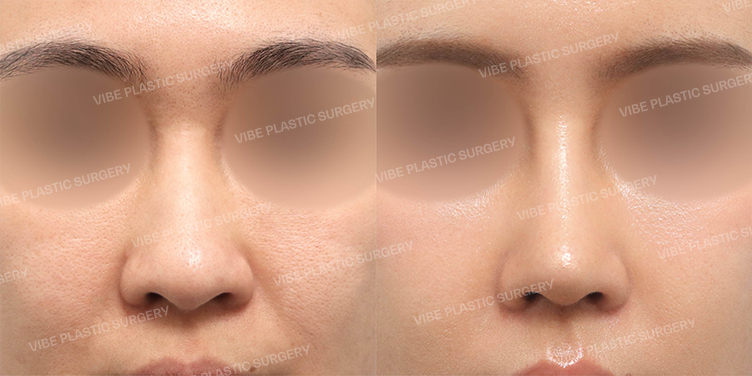 Before/After