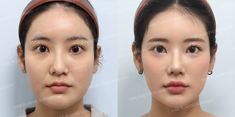 Before/After