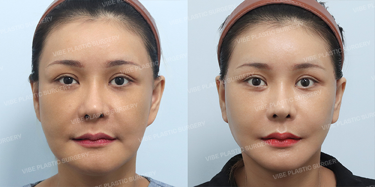 Before/After
