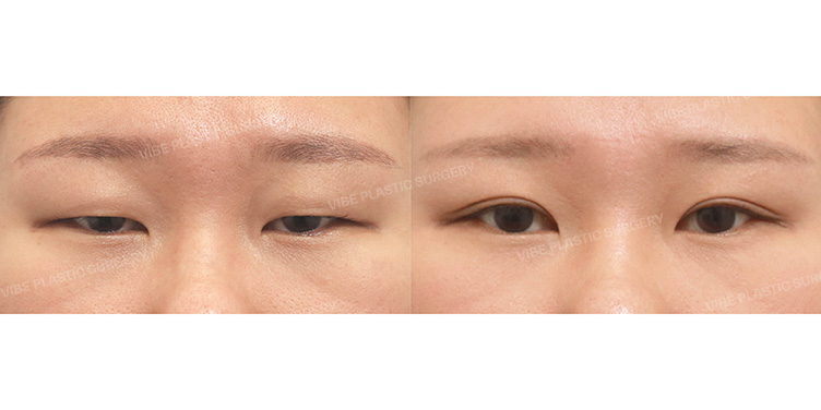 Before/After