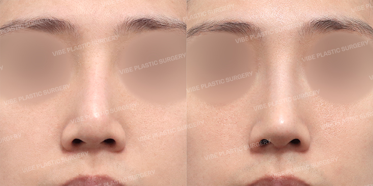 Before/After