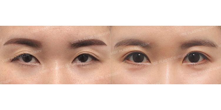 Before/After