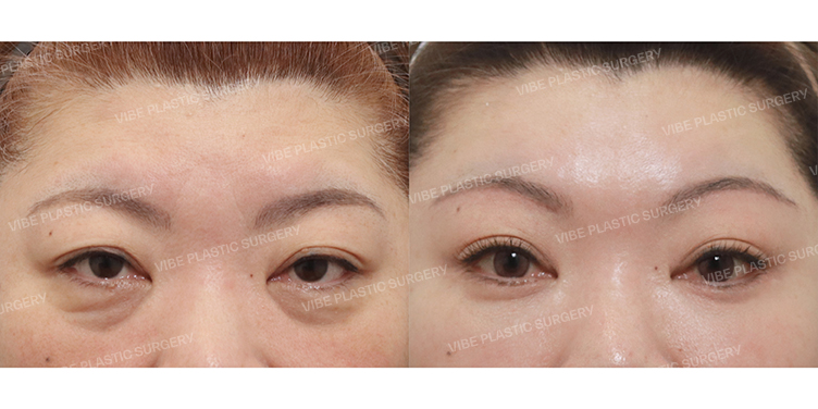 Before/After