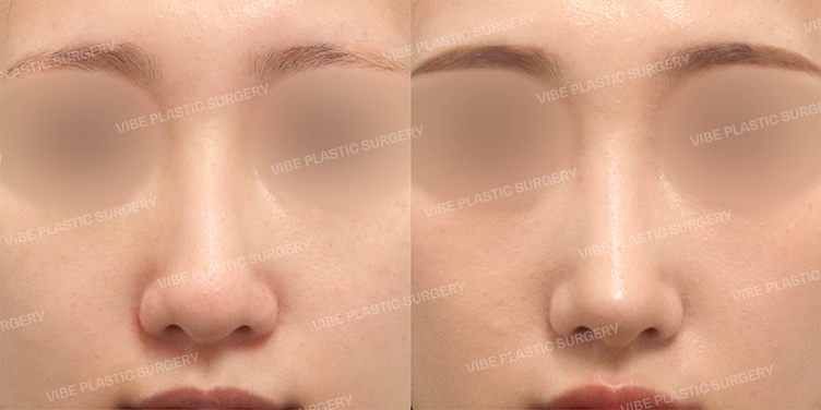 Before/After