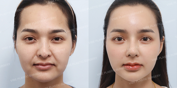 Before/After