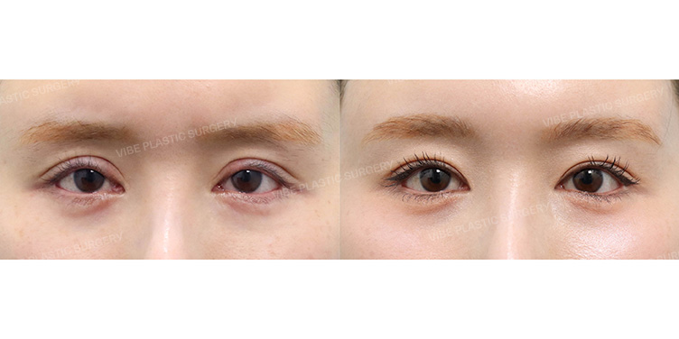 Before/After