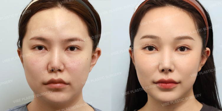 Before/After