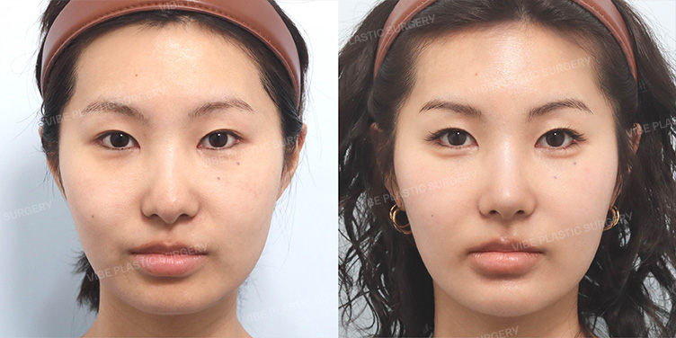 Before/After