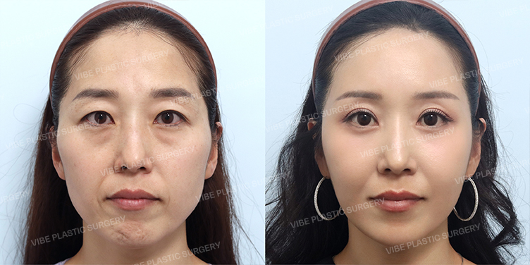 Before/After