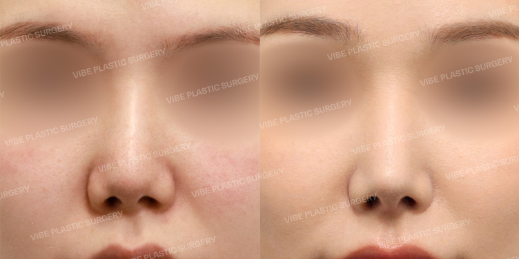 Before/After