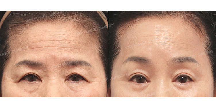Before/After