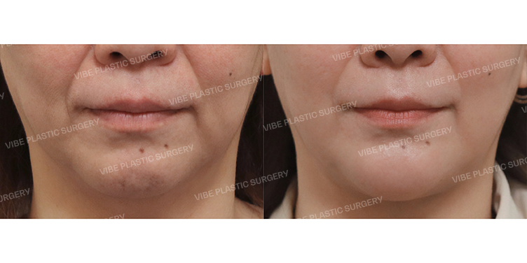 Before/After