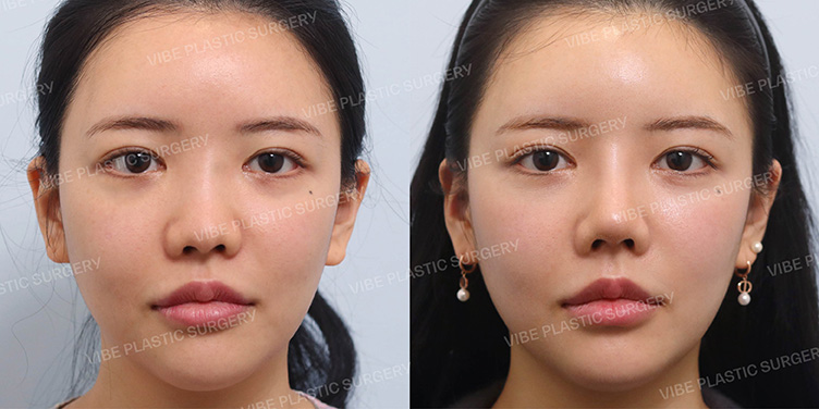 Before/After