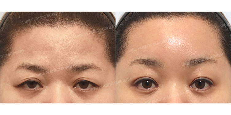 Before/After