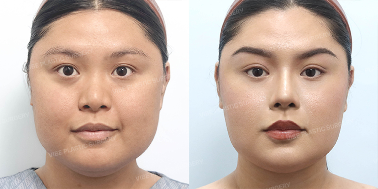 Before/After