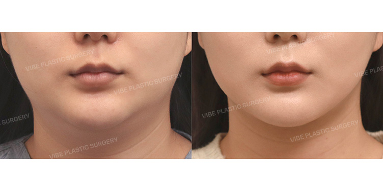 Before/After