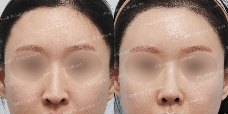 Before/After
