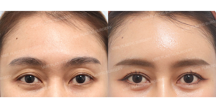 Before/After