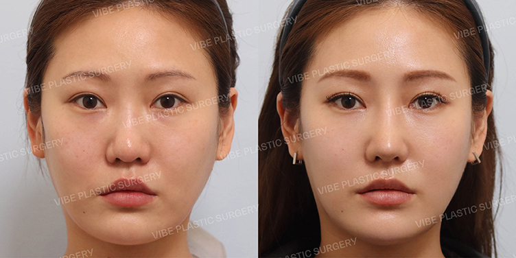 Before/After
