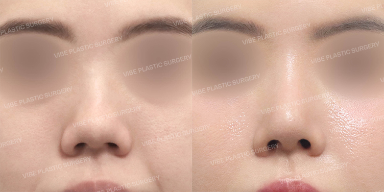 Before/After