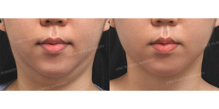 Before/After