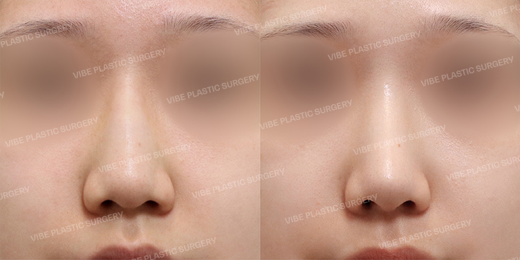 #Implant-free Rhinoplasty #Nose Tip #Hump #Osteotomy #Long Nose #Bulbous Nose