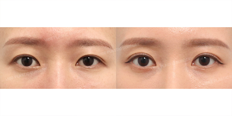 Before/After