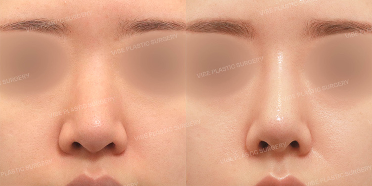 Before/After