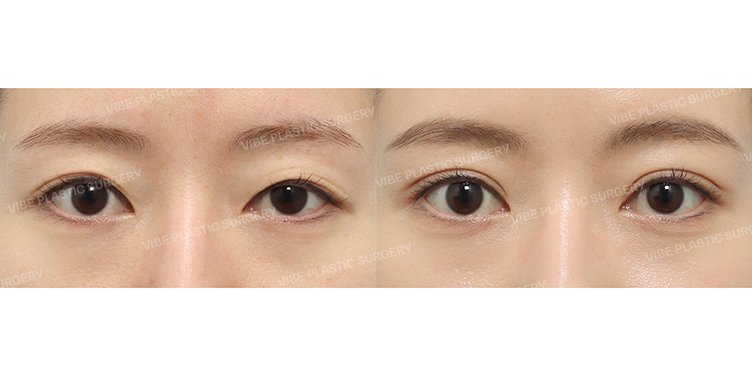 Before/After