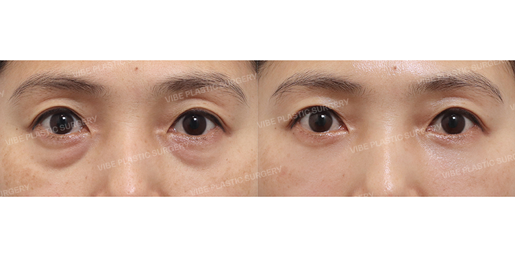Before/After