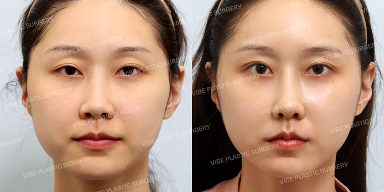Before/After