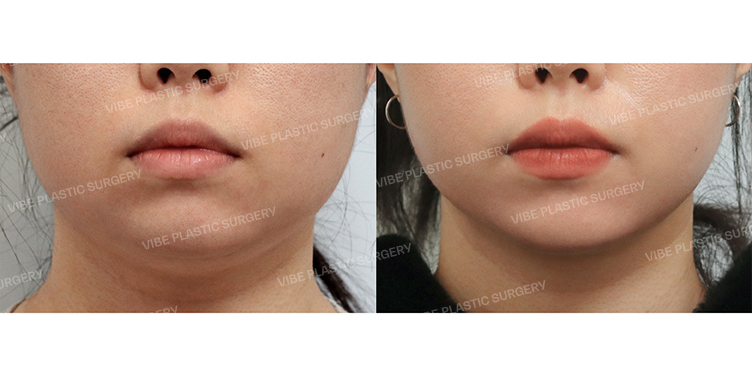 Before/After