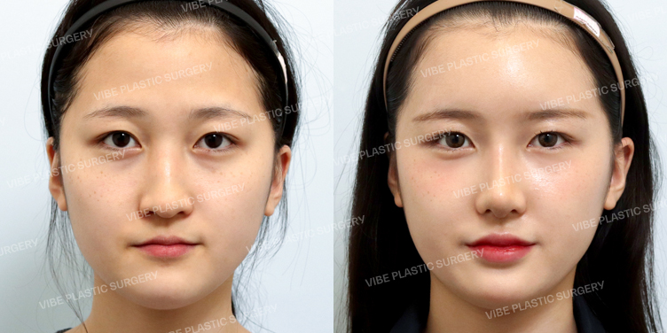Before/After