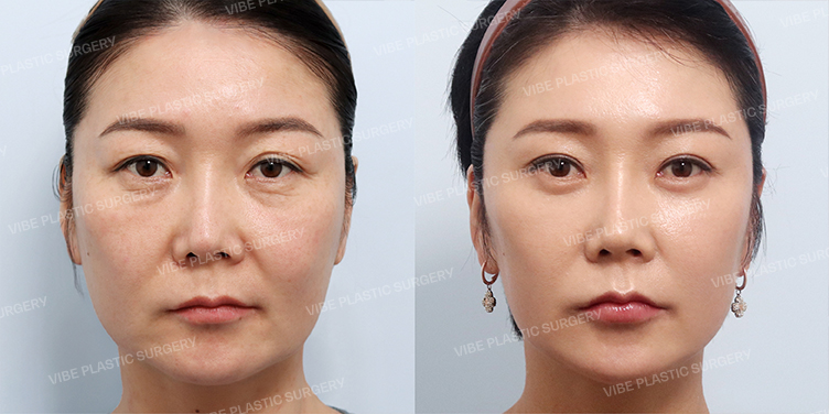 Before/After