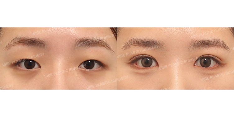 Before/After