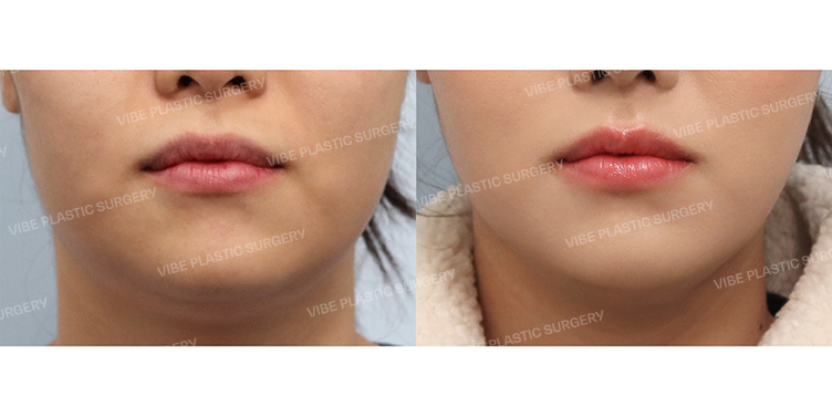 Before/After