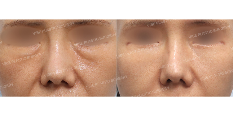 Before/After