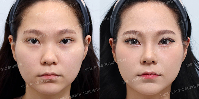 Before/After