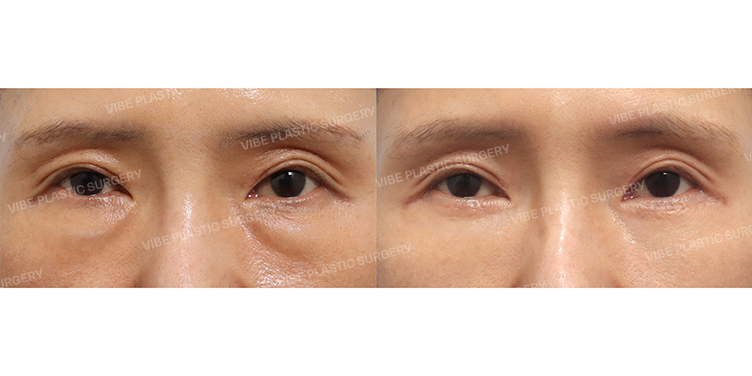 Before/After