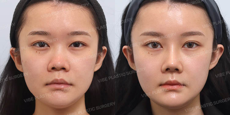 Before/After