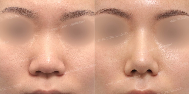 Before/After
