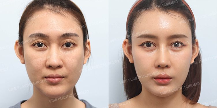 Before/After