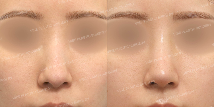 Before/After