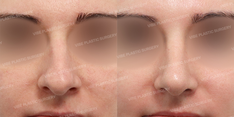 Before/After
