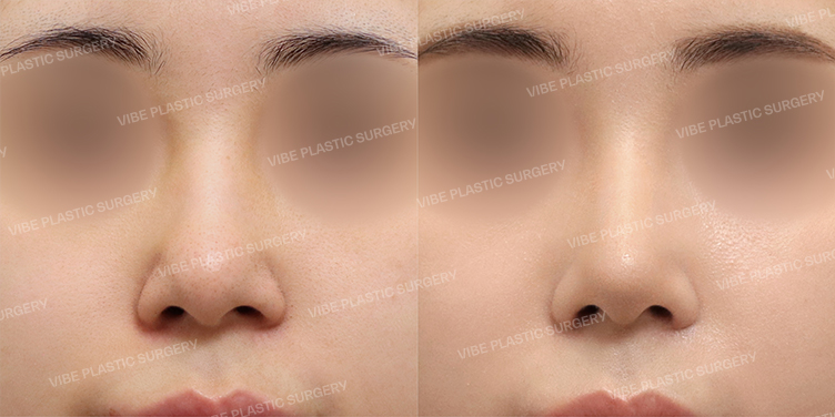 #Implant-free Rhinoplasty #Nose Tip #Hump #Bulbous Nose #Long Nose