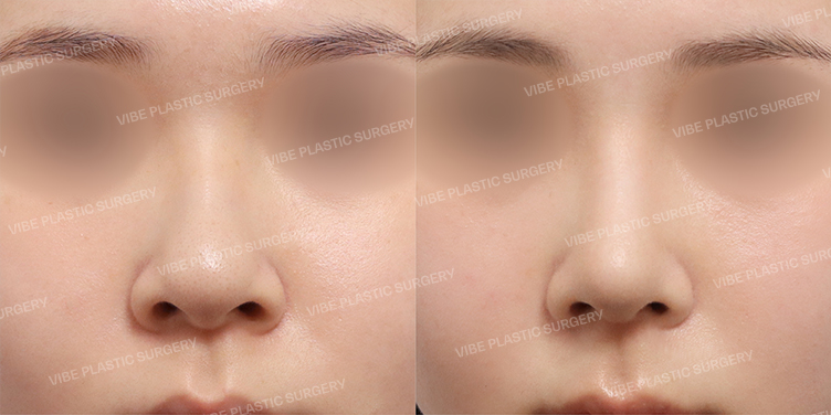 Before/After