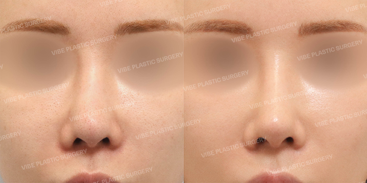 Before/After
