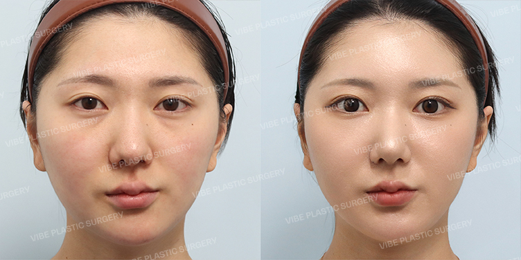 Before/After