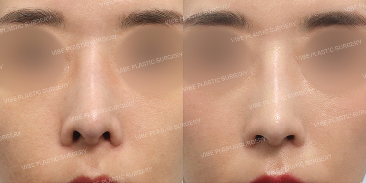 Before/After